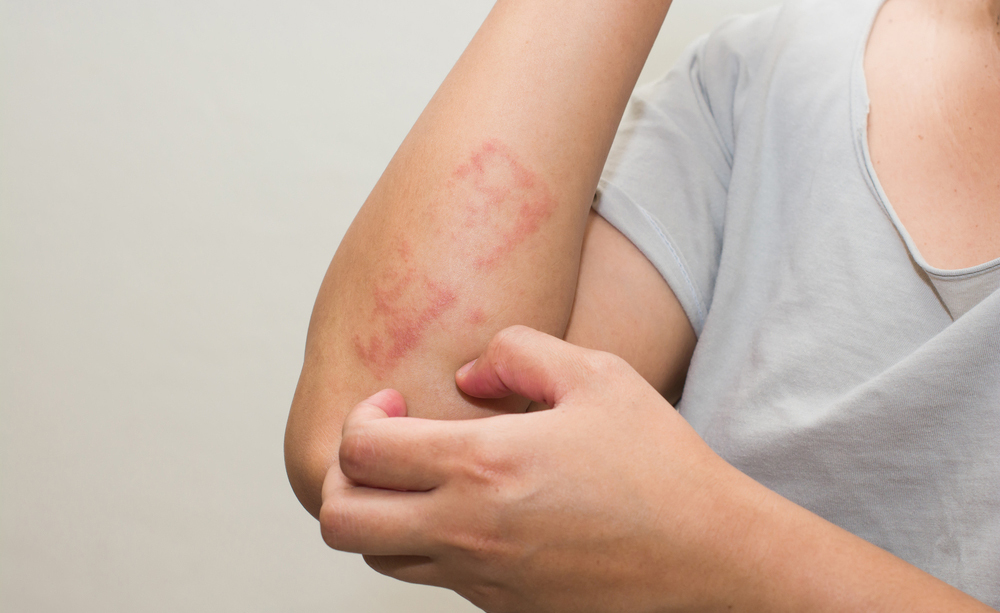 Reazioni allergiche cutanee: vediamo insieme quali sono le cause, i sintomi, come si diagnosticano e si curano le dermatiti
