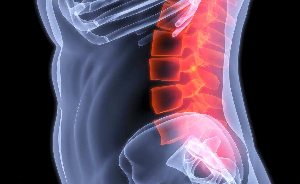 stenosi vertebrale: come trattarla senza bisturi