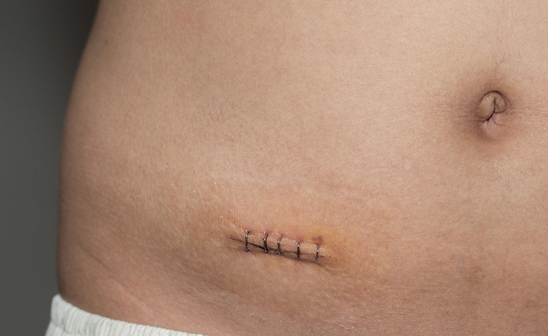 appendicectomia: quali sono le complicanze