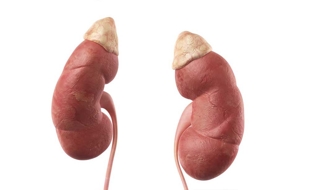 nefropatia diabetica: cause, sintomi e cure