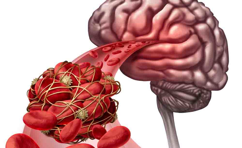ictus: le cattive abitudini che aumentano i fattori di rischio