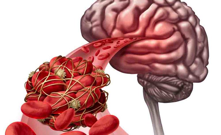 ictus: le cattive abitudini che aumentano i fattori di rischio
