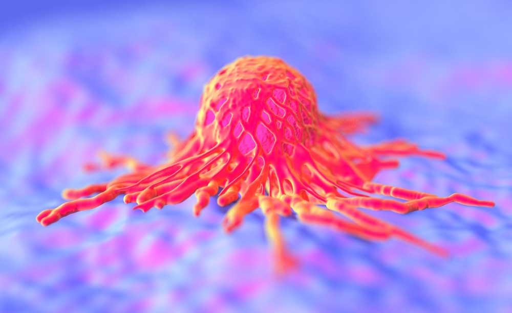 tumore al cervello: un gene potrebbe esserne la causa e condizionare la sopravvivenza dei pazienti