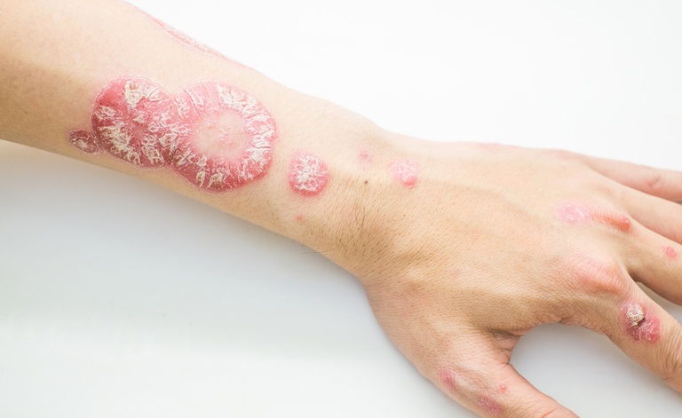 psoriasi: la verità su questa malattia autoimmune