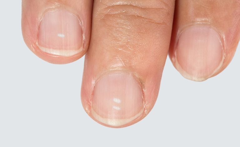 macchie bianche sulle unghie: le cause