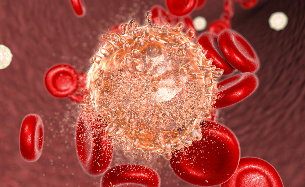 La leucemia mieloide cronica (LMC) è un particolare tipo di tumore del sangue, causato da una mutazione genetica. Diverse sono le cure efficaci.