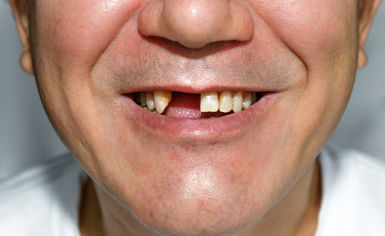 piorrea: come curare i denti che cadono