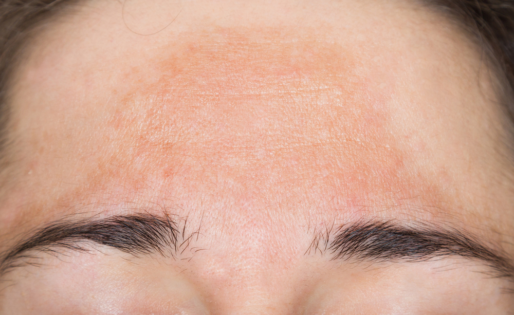 cloasma: le macchie brune sul viso