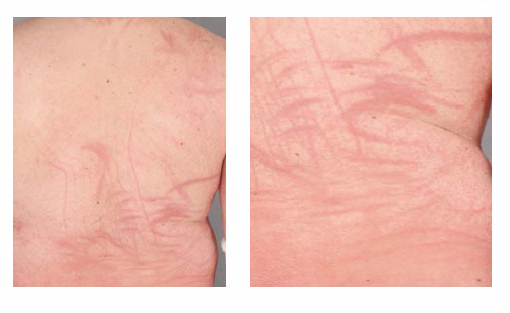 eritema flagellato: quali sono le cause della dermatite