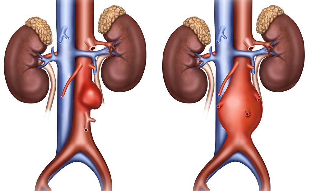 aneurisma aortico: come si presenta