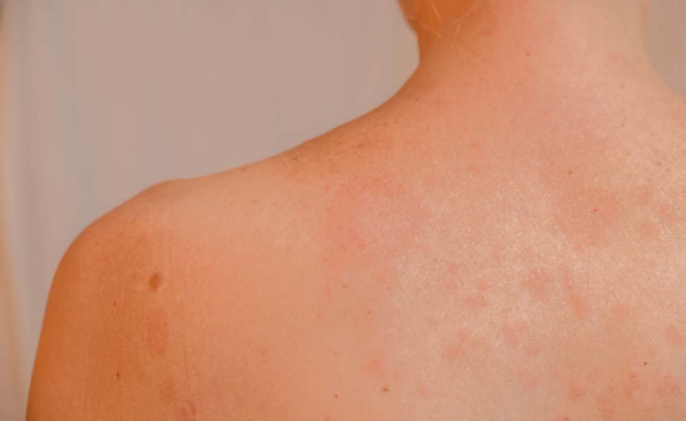 pitiriasi rosea: le cause della dermatite