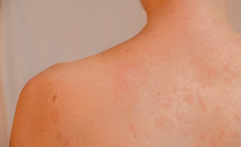 pitiriasi rosea: le cause della dermatite