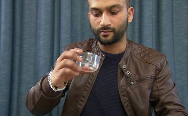 tubercolosi del cervello: la storia di un paziente