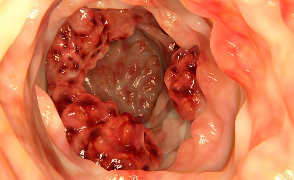 tumore al colon: i rischi