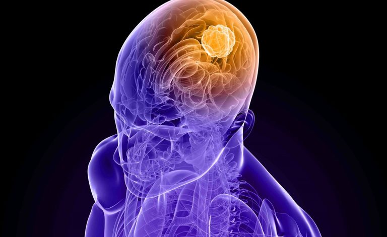 Glioma, glioblastoma e neuroblastoma: come si curano