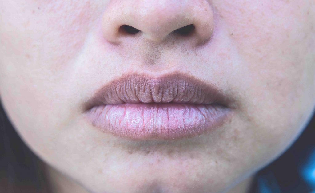 pelle secca: colpa del freddo