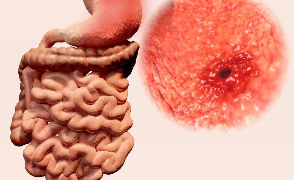 ulcera gastrica: come si fa a riconoscerla, valutando il bruciore o dolore nella zona addominale