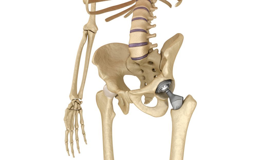 artroprotesi dell'anca: in cosa consiste