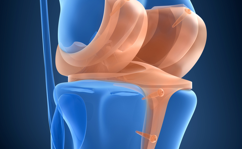 La lesione del menisco