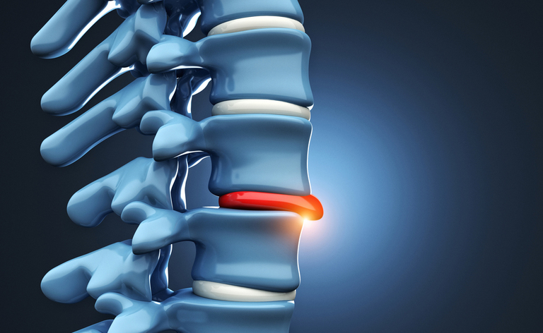 ernia cervicale: i sintomi del disturbo