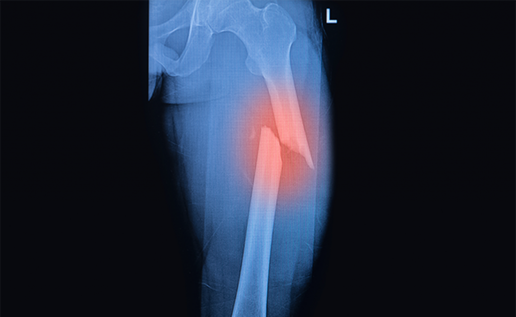 Tutti i rischi (come le fratture) delle cadute negli anziani