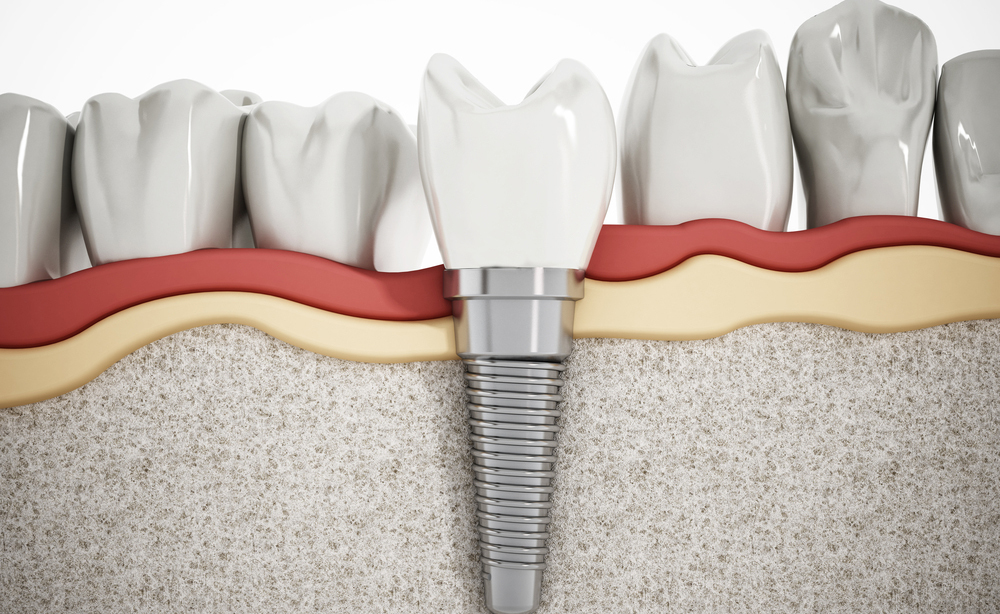 impianto dentale: i rischi