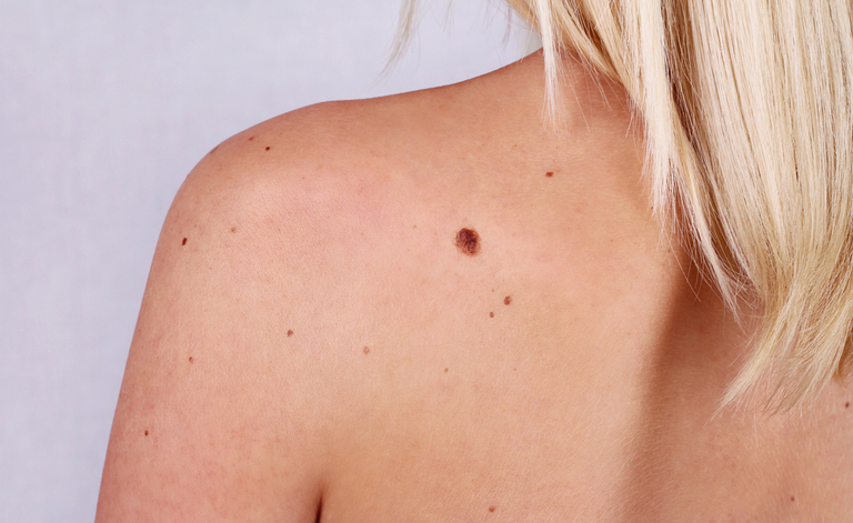 asportazione dei nei