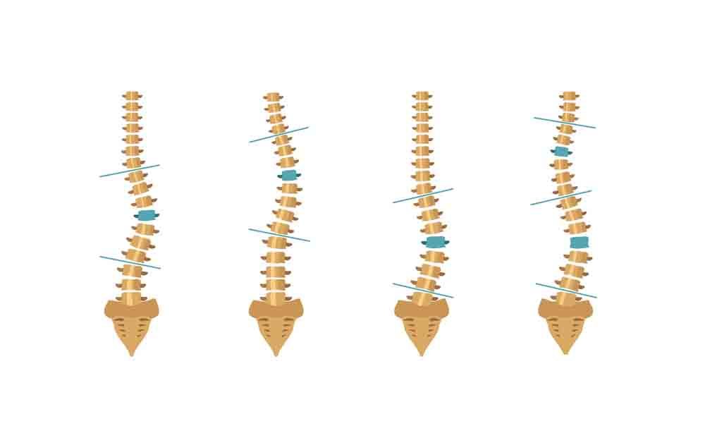 dimorfismi e paramorfismi: come fare a prevenirli