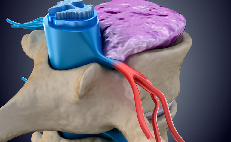 ernia del disco: i benefici della crioterapia