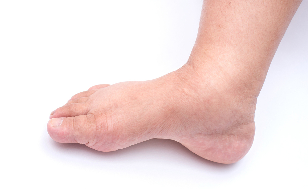 lifedema: come trattarlo con la fisioterapia