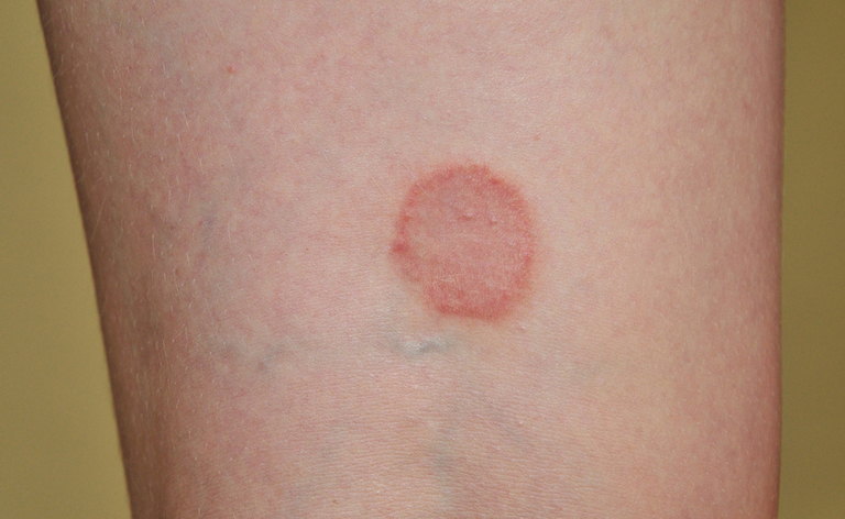 lichen planus
