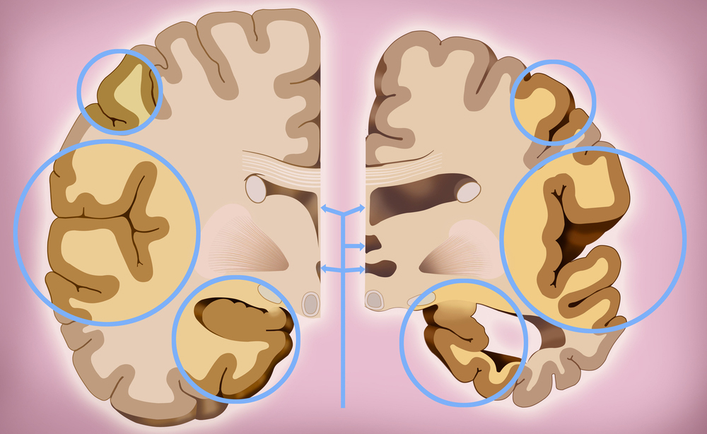 morbo di alzheimer: la cura