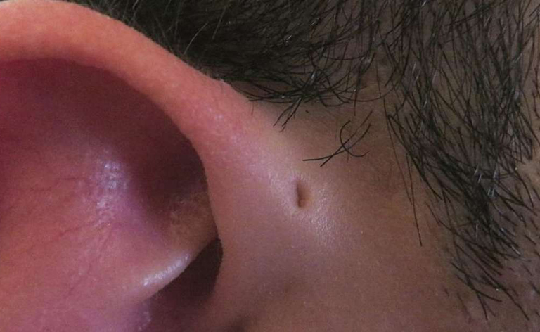 seni preauricolari: gli strani buchi alle orecchie