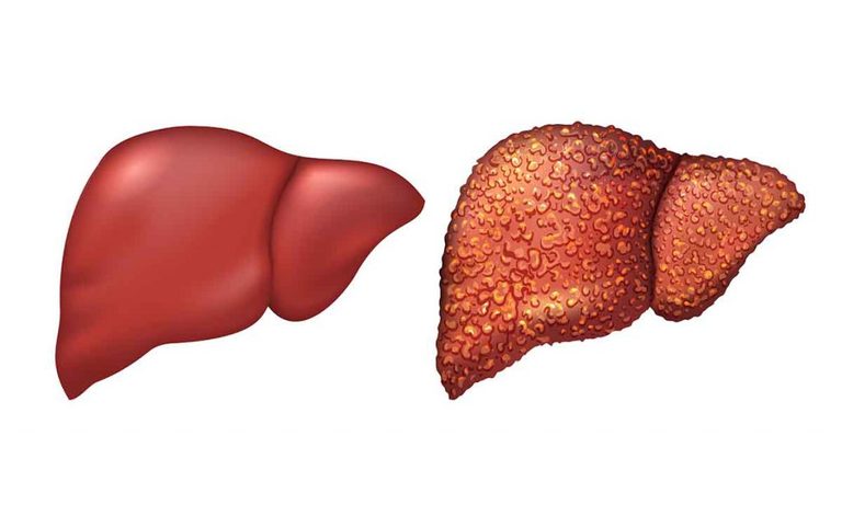 fegato: i sintomi di un disturbo