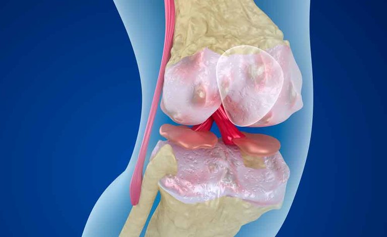 pseudoartrosi: quali sono i sintomi
