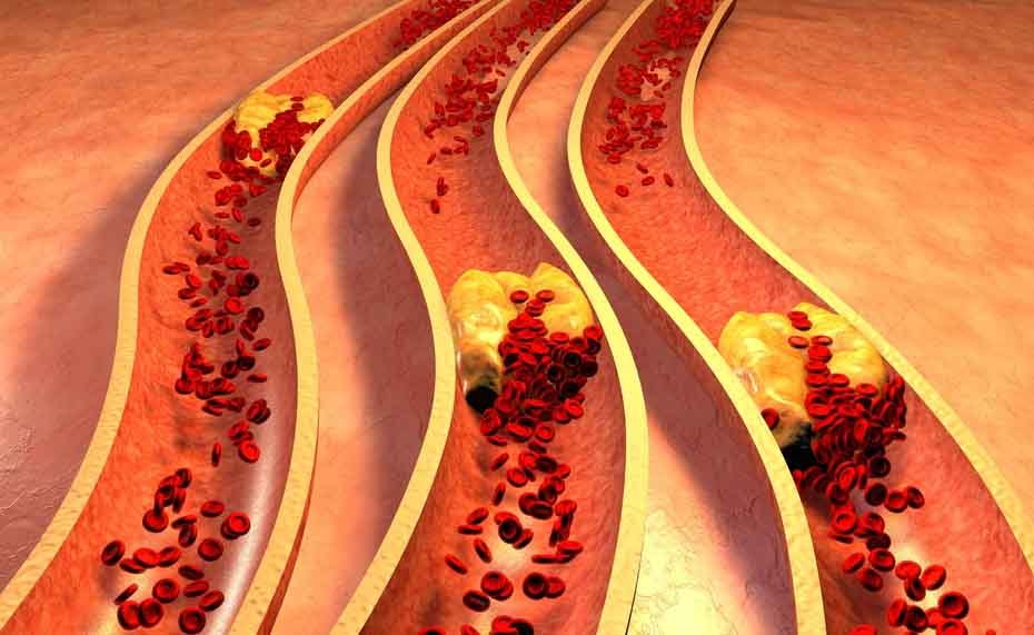 colesterolo alto: gli effetti sul cuore