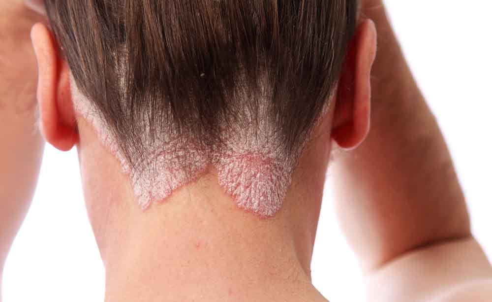 psoriasi: le cause della malattia