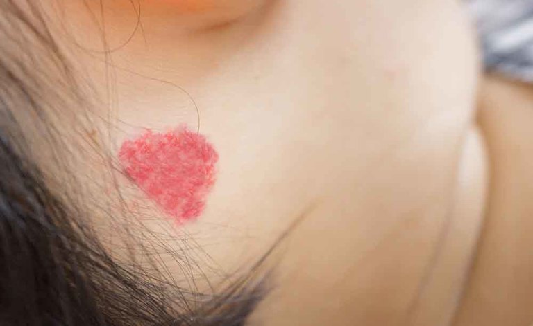 angioma rubino: cosa è e come si cura