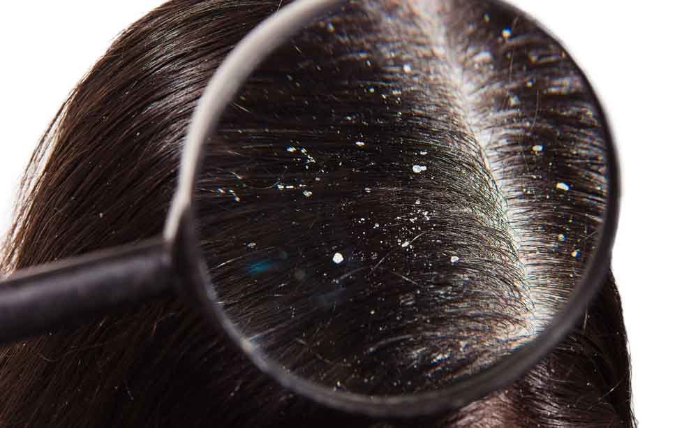 forfora: è contagiosa?