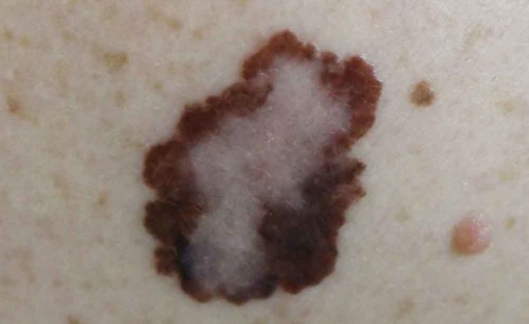 melanoma: i tipi di cancro alla pelle