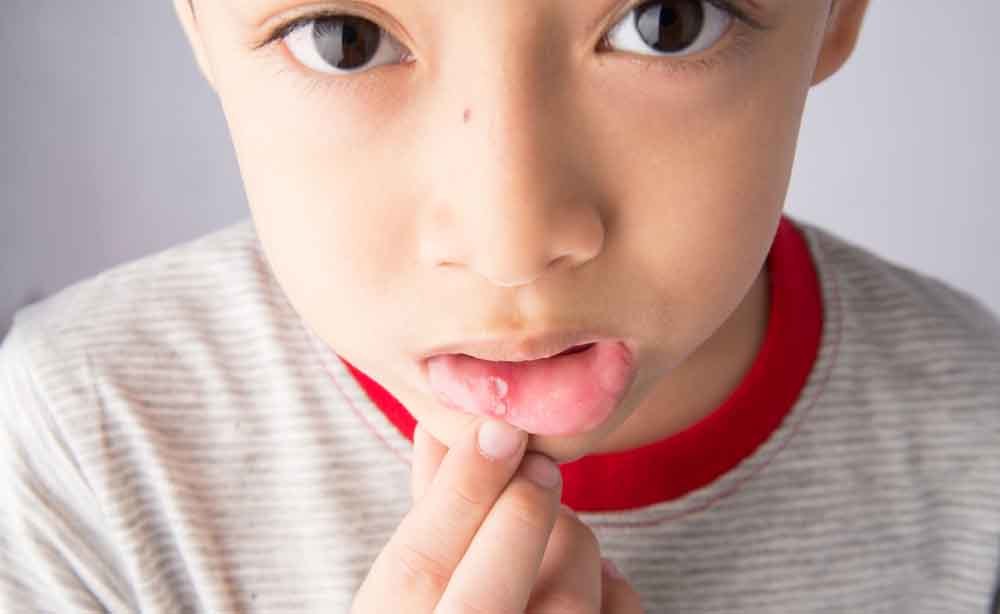 afte: come si curano