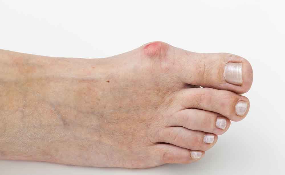 alluce valgo: come si cura