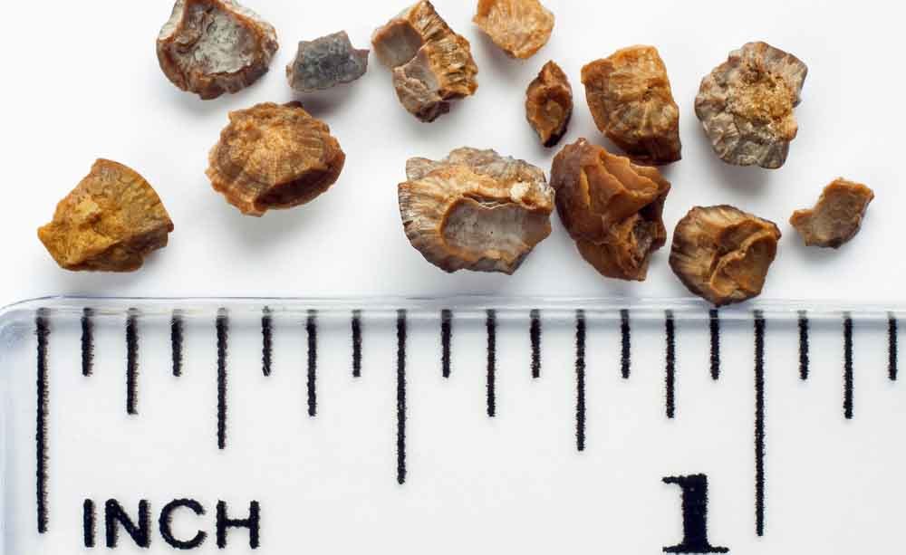 calcoli renali: come curarli