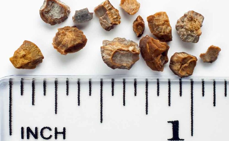 calcoli renali: come curarli