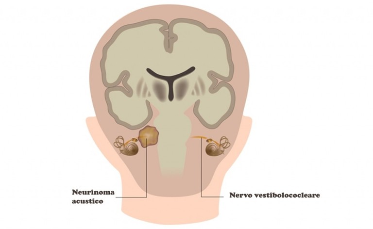 neurinoma acustico: un tumore benigno che causa sordità