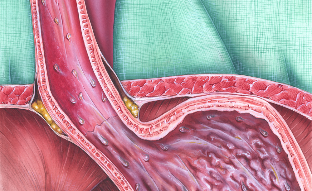 reflusso gastroesofageo: i sintomi