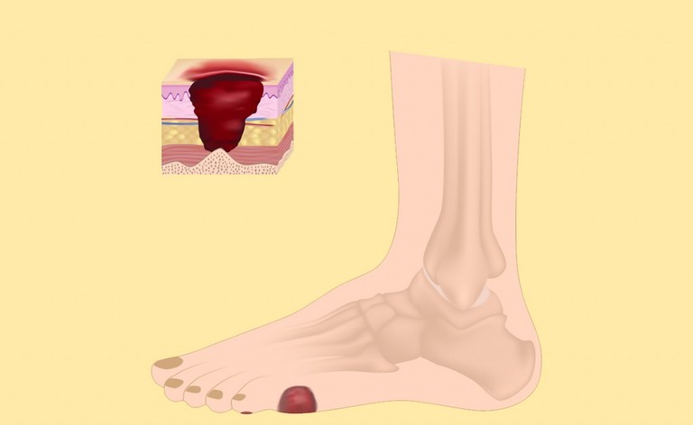 Il piede diabetico: come si cura