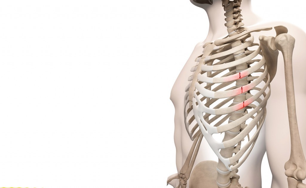 frattura delle costole: gli esercizi di fisioterapia