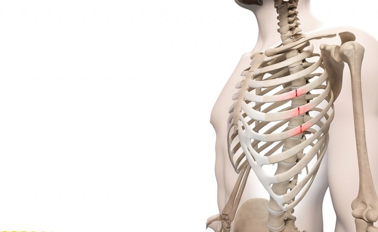 frattura delle costole: gli esercizi di fisioterapia