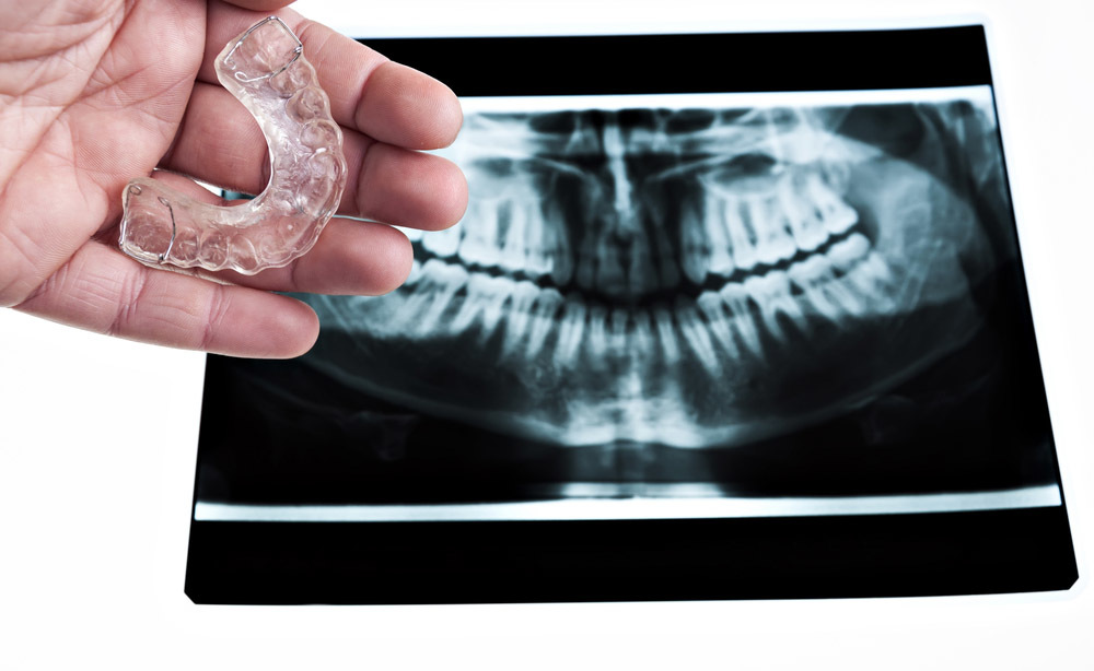 bruxismo: i sintomi del disturbo